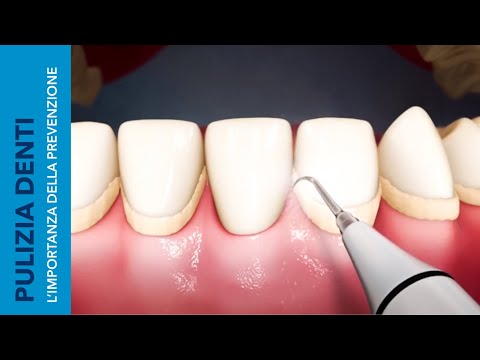 PULIZIA DEI DENTI | L&rsquo;importanza della prevenzione - SkyDental 3D