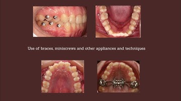 The use of orthodontic appliances before treatment with aligners. My lecture from 2020 - Part 2.