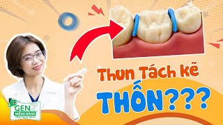 Thun Tách Kẽ Là Gì? Có Phải Bước Thốn Nhất Trước Khi Niềng Răng?