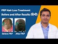 PRP hair loss treatment before and after results in Hindi | Side effects of prp hair loss treatment