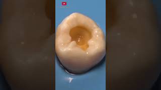 Removing Tooth Decay #shorts