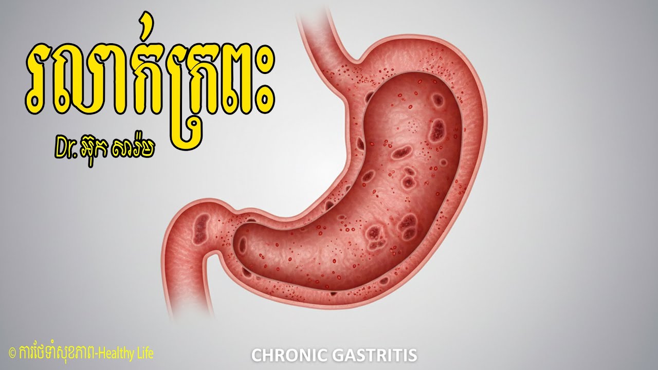 ជំងឺរលាក់ក្រពះរាំរ៉ៃ  CHRONIC GASTRITIS | វិធីការពារកុំឱ្យរលាក់ក្រពះ  | វេជ្ជបណ្ឌិត អ៊ុក សារ៉ម