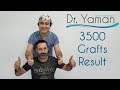 Dr Resul Yaman Hair Clinic - 3500 Grafts 18 Months Result