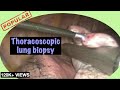 Thoracoscopic (VATS) lung biopsy - Dr Deepraj Bhandarkar