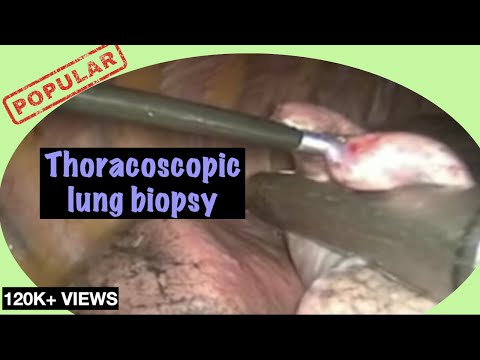 Is a lung biopsy a painful procedure?