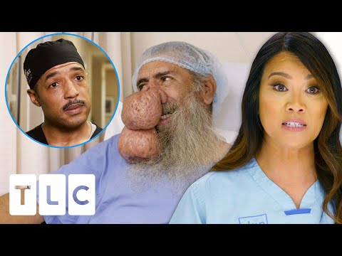 Dr. Lee & Specialists Finally Remove Roger&rsquo;s Enormous Rynophyma! | Dr. Pimple Popper