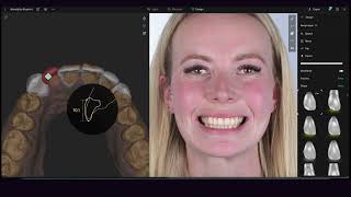Smilecloud 3Dna - From Smile Design To Blueprint Composite Veneers