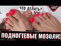 😭УСТАЛА МУЧАТЬСЯ! У клиентки СНОВА ПОДНОГТЕВЫЕ МОЗОЛИ!😫 Педикюр лето 2022😍 Болят ногти на ногах