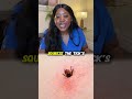Safe Tick Removal: How to Use Tweezers Properly