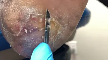 Can you squeeze a corn on your foot?