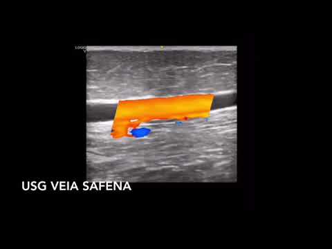 Vídeo: Angiologia De Ultrassom
