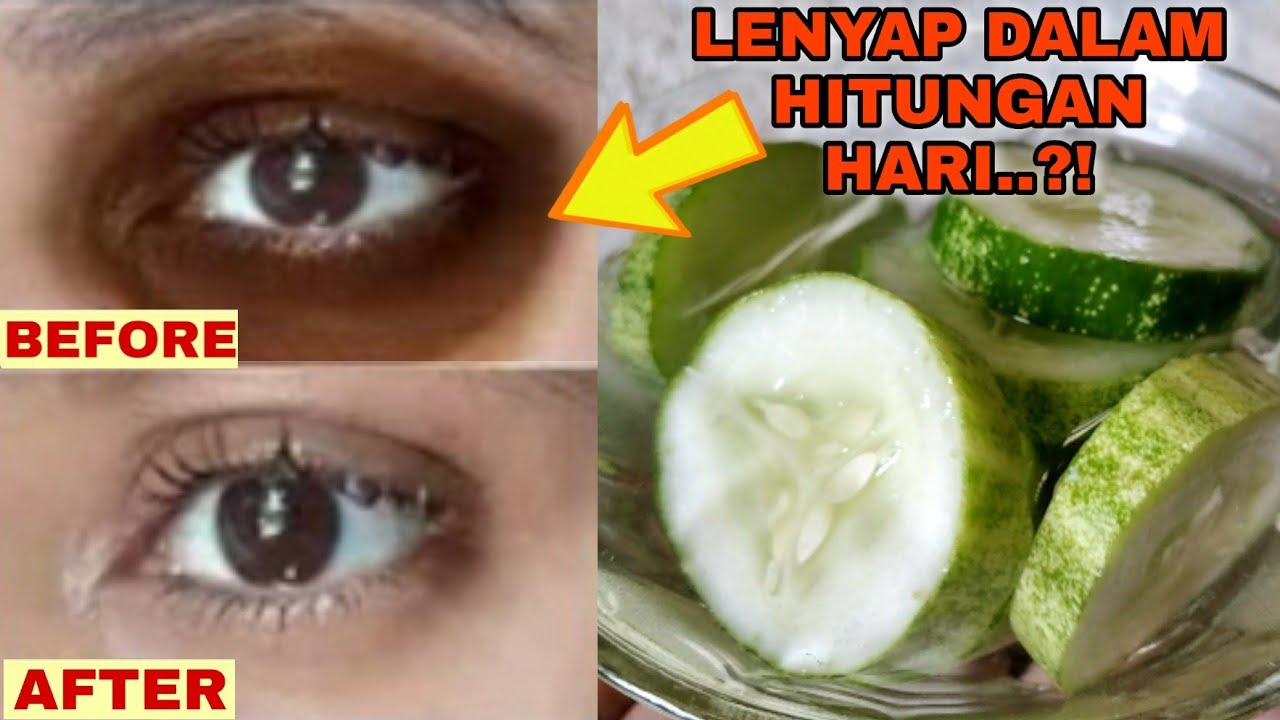 Cara menghilangkan kerutan hitam dibawah mata, kantung