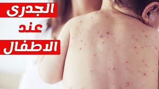 علاج الجدري المائي نهائيآ و الطفح الجلدي و تحذيرات مهمة للغاية لتجنب مضاعفات خطيرة Varicella-Zoster