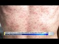 Measles cases continue to grow in northeast Indiana WANE 15 Nightcast