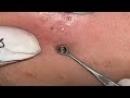 BLACKHEAD REMOVAL WITH COTTON BUDS by DR.LALIT KASANA