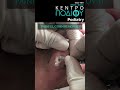 Painful Corn Removal|Αφαίρεση Επίπονου Τύλου|Κέντρο Ποδιού Podiatry|Podiatrist|Podologia|Ποδιατρική