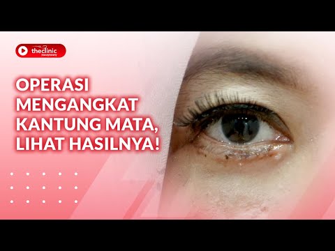 Video: Bedah Kantung Mata: Biaya, Manfaat, Risiko, Waktu Pemulihan, Dan Banyak Lagi