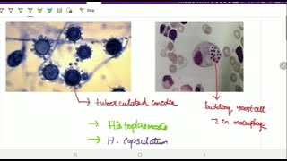 Systemic mycoses | Microbiology | Image based discussion