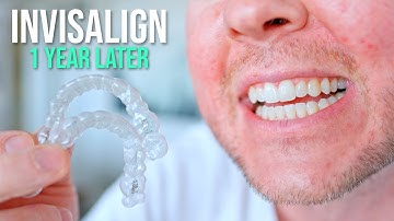 10 dingen die ik had willen weten VOORDAT ik Invisalign liet plaatsen!