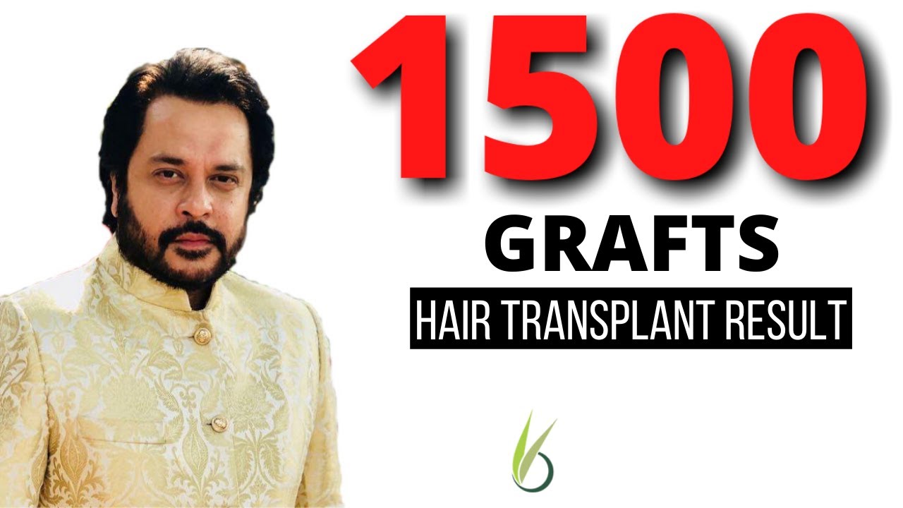 What is a Good Donor Area for Hair Transplant  Rejuvenate Hair