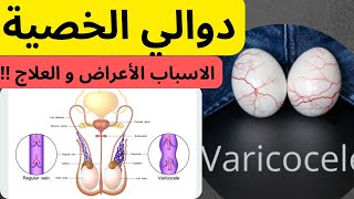 دوالي الخصية، الأسباب الأعراض، التشخيص والعلاج أمراض الجهاز التناسلي الخصية. varicocele. testicles