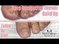 👣Follow Up of Excessive Deep Compacted Toenails How To Pedicure👣