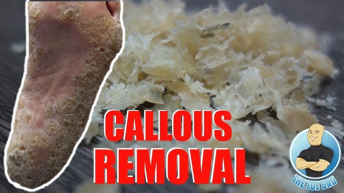 Callus Removal At Home: 5 Top Tips - Northwich Foot Clinic