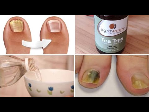 tratament ciuperca unghiilor cu coaja de ceapa vitamine pentru ciuperca unghiilor de la picioare