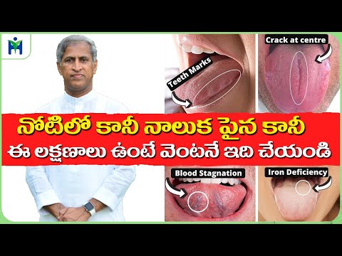 మీ ఆరోగ్యం గురించి మీ నాలుక ఏమి చెబుతుంది | నోటి పుండు | డాక్టర్ మంతెన సత్యనారాయణ రాజు వీడియోలు