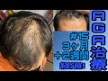 AGA治療3ヶ月+2週間経過！やはり濡れと光はキツいです…涙