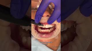 Composite Veneers | Step by Step