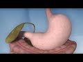 Gastric Bypass Complications - Mayo Clinic