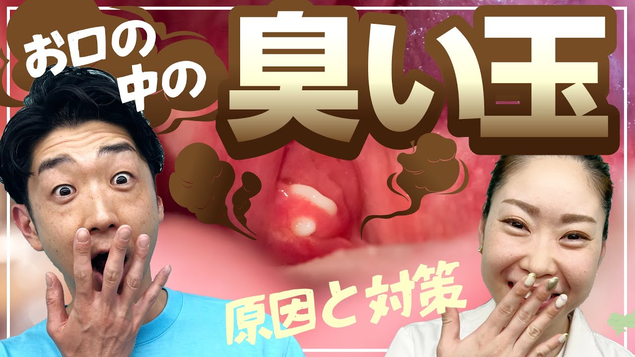口臭の元!?膿栓(臭い玉)の原因と予防方法 - YouTube