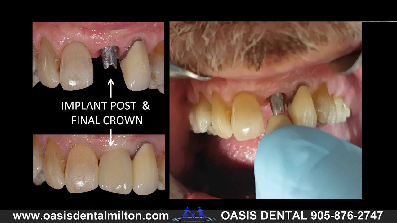 BEFORE & AFTER DENTAL IMPLANT: Upper Front Tooth | Milton, Oakville, Burlington, Mississauga