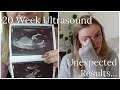 20 Week Ultrasound/Anatomy Scan- Seeing Baby & Unexpected Complications (2 Vessel Umbilical Cord)