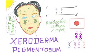 Xeroderma Pigmentosum