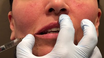 Lip Augmentation with Cannula by Sachin Shridharani