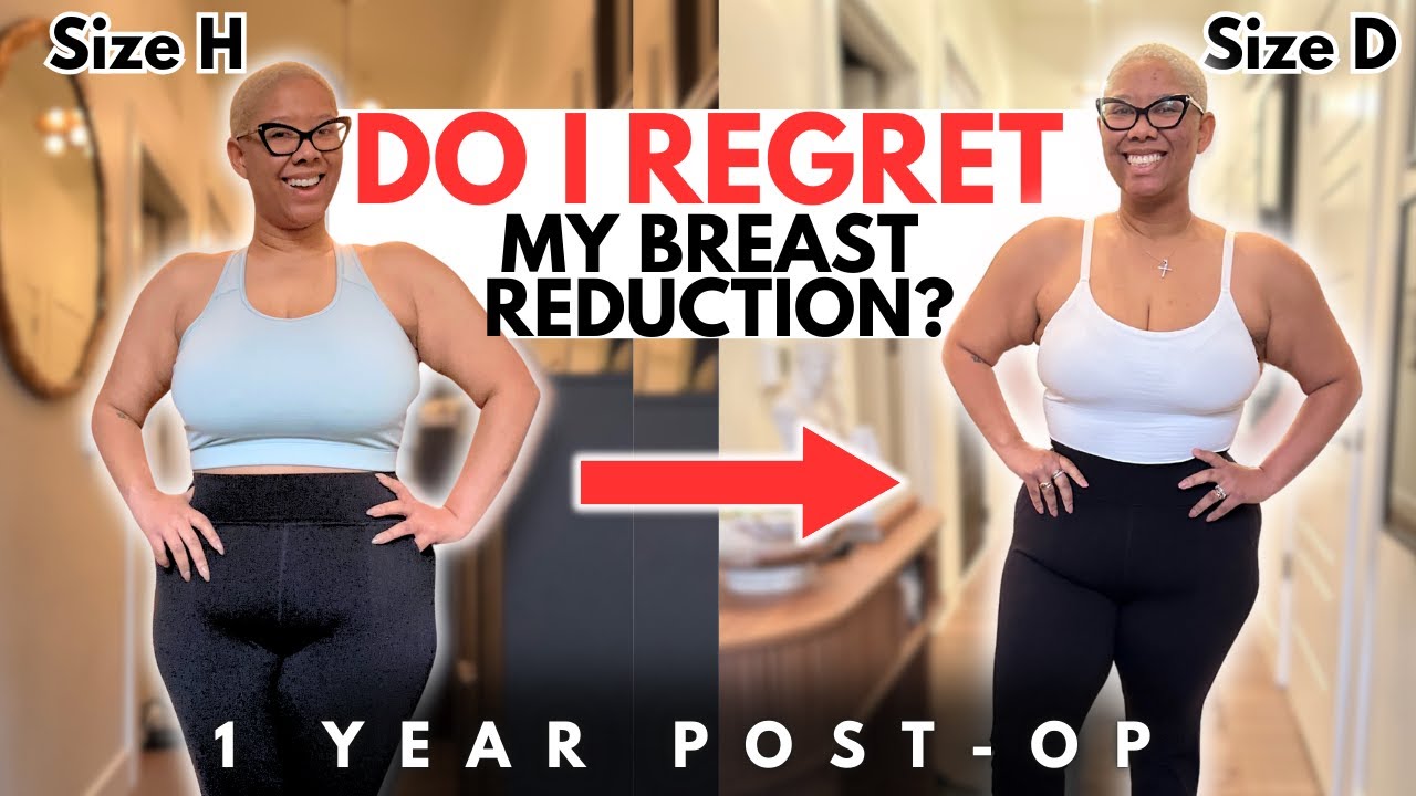 10 Things I Wish I Knew Before Having a Breast Reduction | 1 Year Post Op