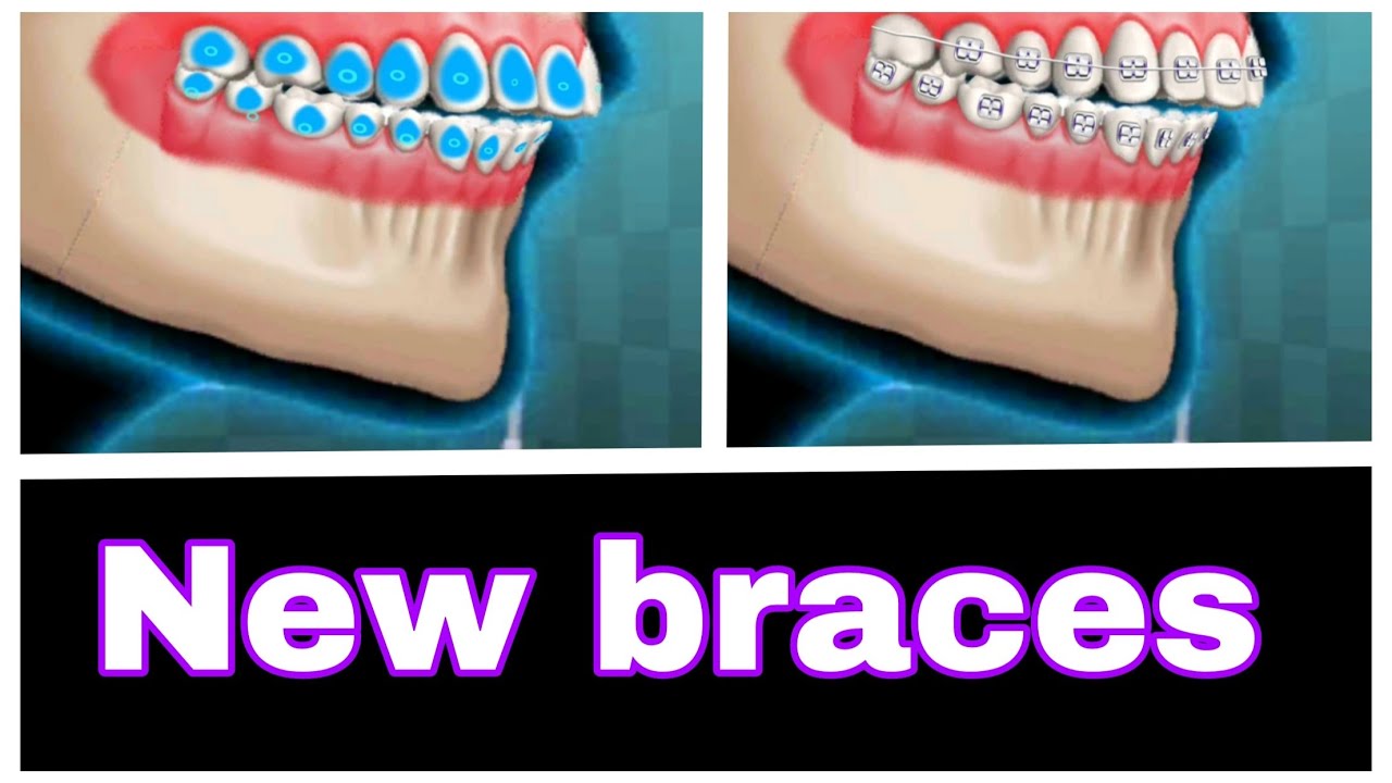 ASMR 🦷🦷 New braces for teeth animation video YouTube