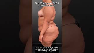 TWO YEARS after Plus Size Tummy Tuck® with Dr. Repta. plussizetummytuck nobmilimit liposuction