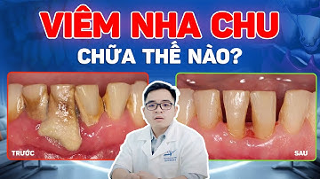 Viêm Nha Chu: Giữ Răng Hay Phải Nhổ Bỏ? Dấu Hiệu Nhận Biệt Viêm Nha Chu Giai Đoạn Muộn