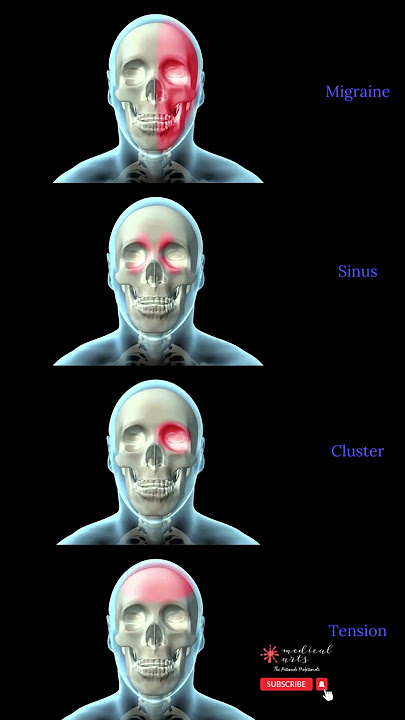 Different Types Of Headaches: Migraine, Sinus, Cluster, Tension.. #shorts