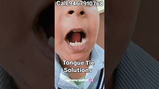 Tongue Tie Solution #clearspeech #speechtherapy #speechtherapyforkids #speechpathologist #tonguetie
