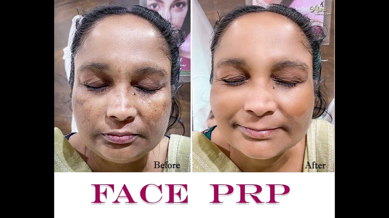 𝐅𝐀𝐂𝐄 𝐏𝐑𝐏 N𝐨𝐧S𝐮𝐫𝐠𝐢𝐜𝐚𝐥 T𝐫𝐞𝐚𝐭𝐦𝐞𝐧𝐭 Best Skin Care Clinic Kolkata