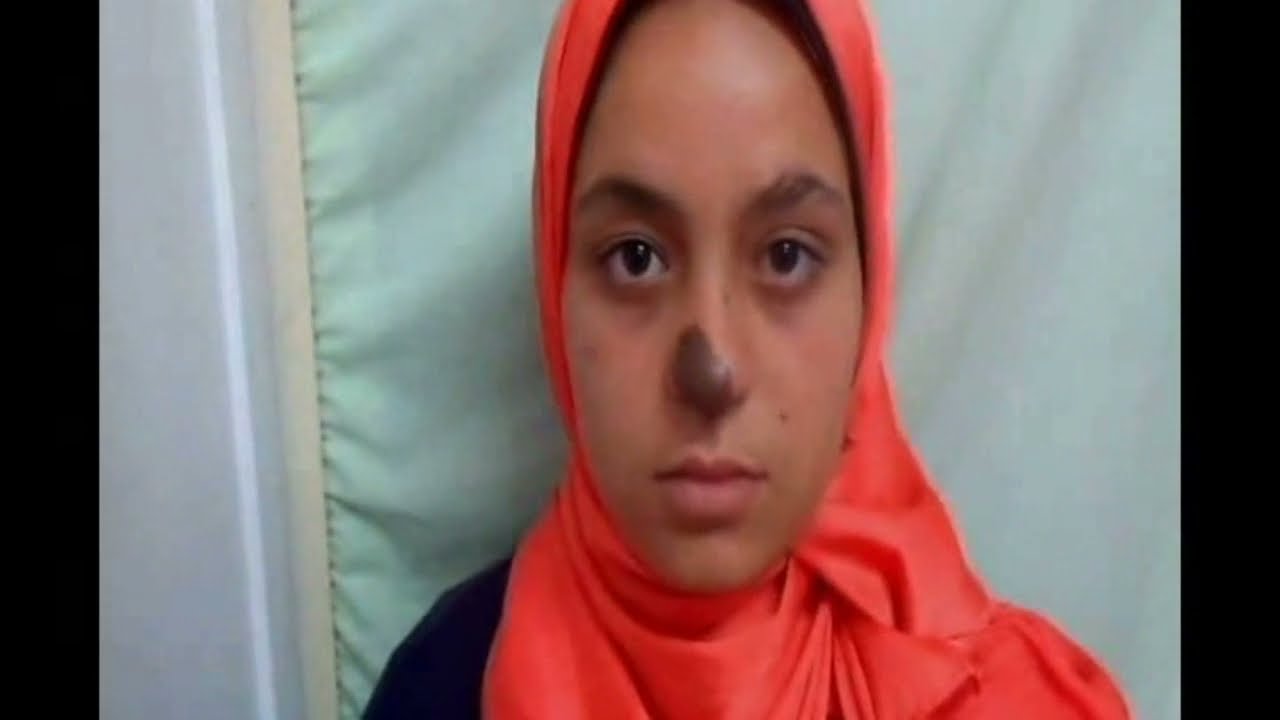 Aesthetic remoal of congenital melanocytic nevi without surgery ..CMN..By Dr Nader Elmelegy