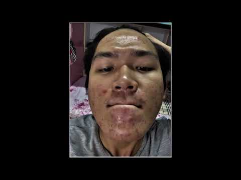 Acne update (One month on doxycycline)