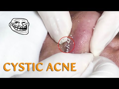 CYSTIC ACNE EXTRACTION ON NOSE