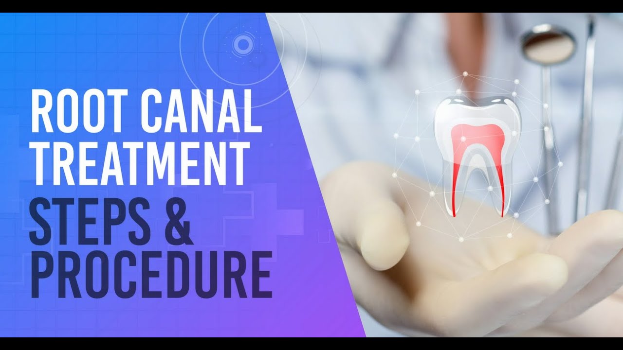 Dental Clinic In Udaipur ll Root canal treatment Steps ll Mumbai