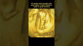 16 Week Twins Fought with each other in the Mothers Womb pregnancy pregnant shorts