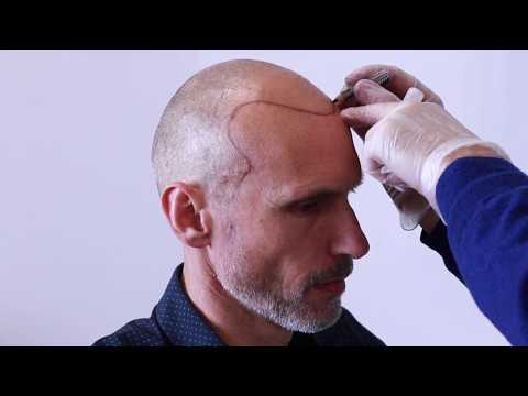 scalp-micropigmentation-|-hair-tattoo-melbourne-|-smp-clinic